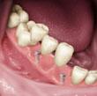 artificial-teeth