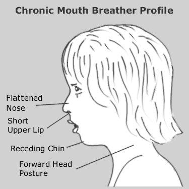 chronic-mouth-breather