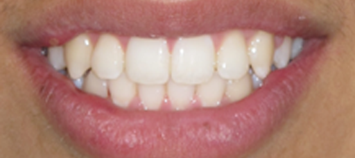 clear-braces-result002