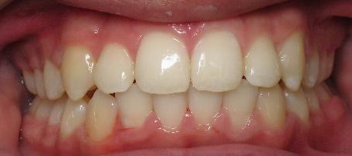 clear-braces-result1