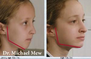 facial-growth-abnormalities