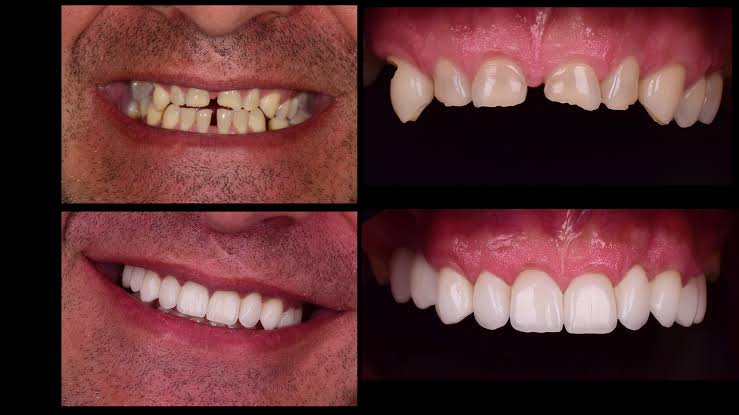 full mouth rehab before and after