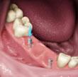 surgical-below-gums